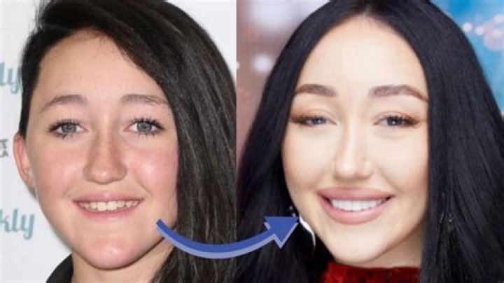 Noa Kirel Plastic Surgery
