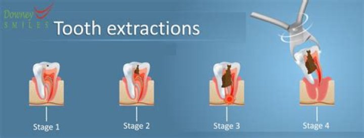 paying for tooth extraction without insurance paying for tooth extraction without insurance