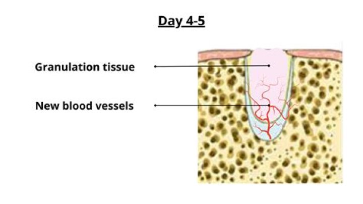 Recovery Period After Tooth Extraction Recovery Period After Tooth Extraction