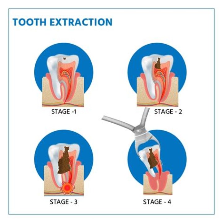 tooth extraction procedure tooth extraction procedure