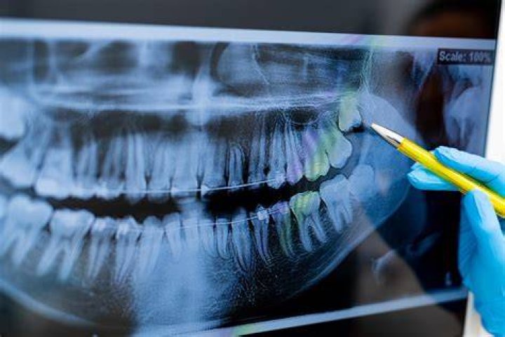 X-rays for extraction X-rays for extraction
